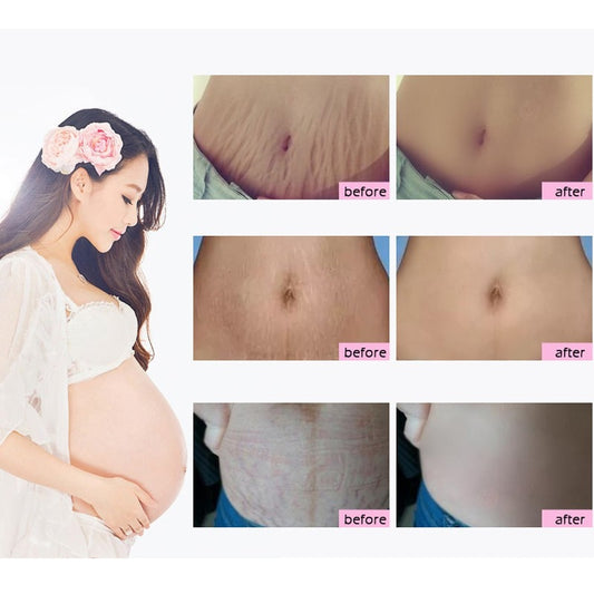 Firming Body Cream Helps to Diminish Stretch Marks and Scars - Mango