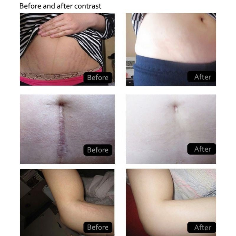 PasJel Stretch Mark and Scar Diminishing Body Cream - 1 Jar